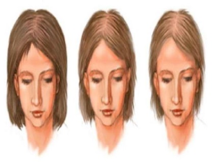 Difuze pierderea parului este ceea ce este, cauzele si tratamentul alopeciei (difuze cauze alopecie) Pierderea parului este Difuze ceea ce este, cauzele și tratamentul alopeciei