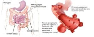 Tratamentul intestinului diverticuloza de remedii populare