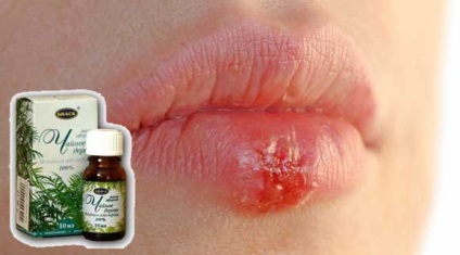 Ulei esential de leziuni herpetice pe buze, tratament la domiciliu (herpes) Ulei esential de leziuni herpetice pe buze, un tratament la domiciliu