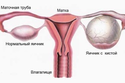 Hemoragica tratament chist ovarian (chist) Hemoragica tratament chist ovarian