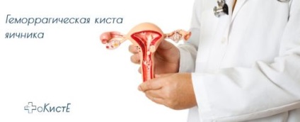 Hemoragică chist ovarian - tratament, simptome, prognosticul (chist) chist ovarian hemoragică - tratament, simptome, prognosticul