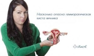 Hemoragică ovarian chist - tratament, simptome, prognosticul (simptome) chist ovarian hemoragică - tratament, simptome, prognosticul