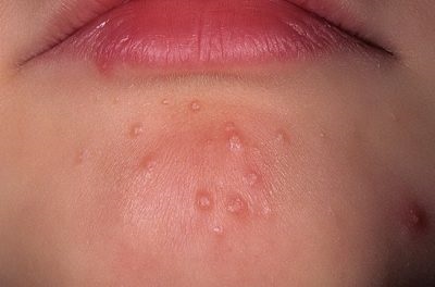 Herpes pe bărbie cauzează simptome și vindecarea (leziuni herpetice) Herpes pe bărbie și provoacă simptome decât pentru a trata