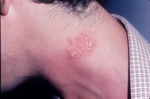 Herpes pe tratament gat, cauze si simptome