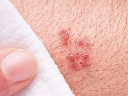 Herpes pe abdomen (abdominale) Herpes pe stomac