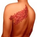 Herpes pe fotografie abdomen, virusul herpetic (virusul) Herpes pe fotografie abdomen, virusul herpetic