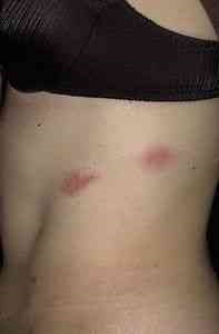Herpes pe stomac - boli infecțioase - Articole Director - populare rețete medicinale (ale bolii) Herpes pe stomac - boli infecțioase - Articole Director - retete populare medicinale