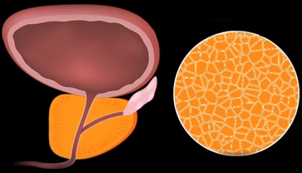 hipertrofie de prostată sau cancer de prostata, care este si tratata