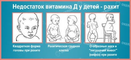 Simptomele hipocalcemiei, cauzele de hipocalcemie la copii și adulți tratați pentru hipocalcemie (simptome) Simptomele hipocalcemiei, cauzele de hipocalcemie la copii și adulți, tratamentul hipocalcemiei