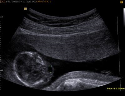 hipoplazie fetal (fetus) hipoplazie fetale