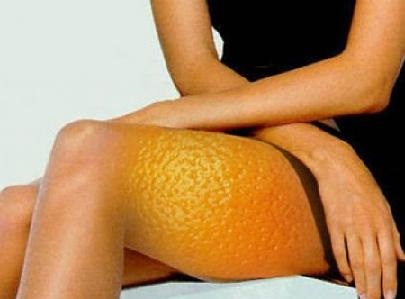 anticelulita Hirudoterapia (girudoterapija) hirudoterapia celulita