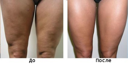 Hirudoterapia anticelulita (1500 Hirudoterapia tratarea celulitei) hirudoterapia celulita