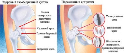 Infectarea Artrita reumatoida - ceea ce este și cum să-l lupta