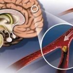 Accident vascular cerebral - Tipuri, simptome, diagnostic si tratament în timp util (tratamentul de droguri accident vascular cerebral ischemic) Accident vascular cerebral - Tipuri, simptome, diagnostic si tratament in timp util