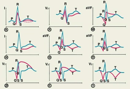 Cum să învețe să citească ECG (cum să învețe) Cum să învețe să citească ECG