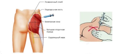 Cum sa faci o înțepătură-te (do) Cum de a face o lovitură el însuși
