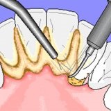Cum de a elimina tartrul cu parodontoza severă - bisturiu - medicale (dentare) Cum de a elimina tartrul cu parodontoza severă - bisturiu - medical
