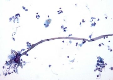 simptome de amigdalită Candida la copii și adulți, tratament, foto (angină Candidei) simptome de amigdalită Candida la copii și adulți, tratament, fotografii
