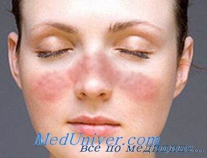 Clinica și diagnosticul de lupus eritematos sistemic (LES), la copii (diagnosticare) Clinica și diagnosticul de lupus eritematos sistemic (LES) la copii