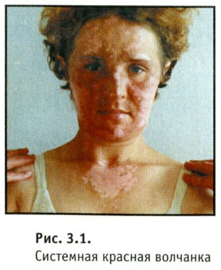Clinica lupus, simptome, semne, fotografii (manifestare) Clinica lupus, simptome, semne, fotografii