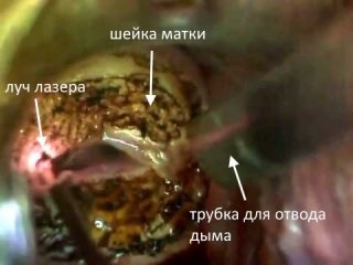 coagulării de col uterin - ce este, tipurile de coagulare (coagulare) De col uterin de coagulare - ceea ce este, tipurile de coagulare