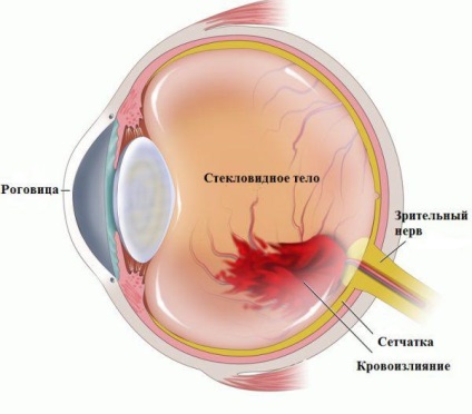 Hemoragie în ochi ce să facă în cazul în care corpul vitros, sclera - cauze si tratament picaturi (cauza) Hemoragia în ochi ce să facă în cazul în care corpul vitros, sclera - cauze si tratament scade