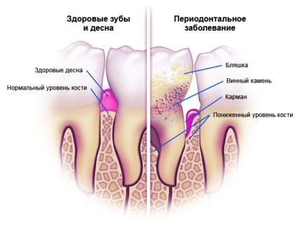 Tratamentul bolii parodontale în Yekaterinburg simptome ieftine ms stomatologie Factori (simptome) Tratamentul bolii parodontale în Yekaterinburg ms ieftine stomatologie simptome, factori