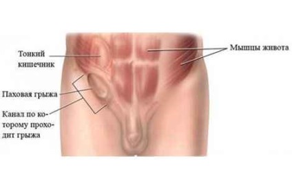 Tratamentul inghinala Hernia remedii populare (hernie) Tratamentul de remedii populare hernie inghinala