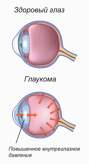 picături pentru ochi Cure glaucom, preparate - tratament, simptome, prevenire (droguri) Cure pentru ochi glaucom picături, medicamente - tratament, simptome, prevenirea