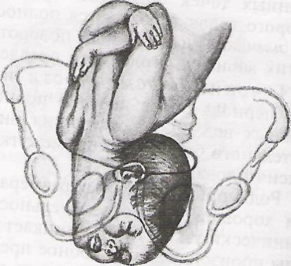 Se confruntă cu consecințele prezentării fetale (facial) Se confruntă cu consecințele prezentării fetale