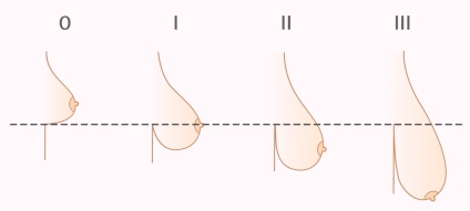 Mastoptoz (ptoză de san, sani saggy) cauze si tratament, prețul de chirurgie (foto) (mastoptoz san droops cauza de tratament) Mastoptoz (ptoză de san, sani saggy) cauze si tratament, prețul operațiunii (foto)