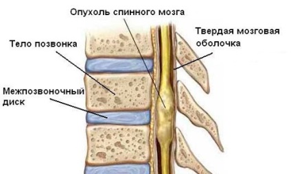 Meningiom cauze, simptome, tratament, remedii populare, prognoza (cauza) Meningiom cauze, simptome, tratament, remedii populare, prognoza