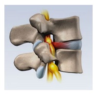 Herniate (Simptome herniat) hernie intervertebral