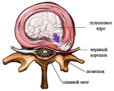 dureri de spate neurologice (dureri de spate de la nervi) Neurologice dureri de spate