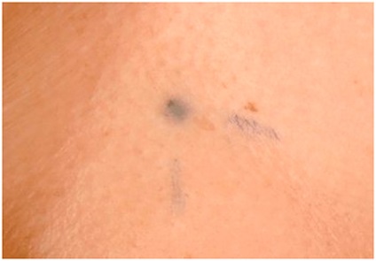Iradierea în cancerul de vezică urinară și efectele secundare (vezica urinara) Iradierea de cancer de vezică urinară și efectele secundare