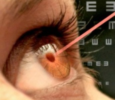 Limitări și contraindicații următoarele corectarea vederii cu laser (contra) Limitări și contraindicații după corectarea vederii cu laser