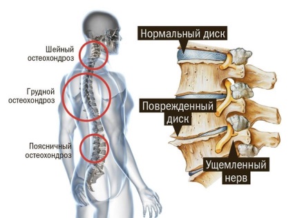 Operarea în indicații și contraindicații osteohondroză (mărturie) Operarea în indicații osteohondroză și contraindicații