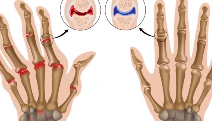 articulații tumefiate ale degetelor ce să facă