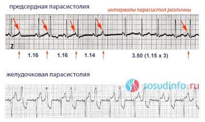 semne Parasystole, tratament ECG, ventriculară și atrială