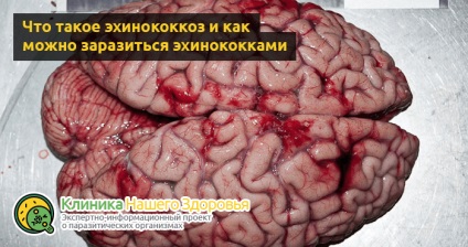 Parazitează în simptome cerebrale, tipuri și tratament (specii) Paraziți în simptomele creierului, tipuri și tratament