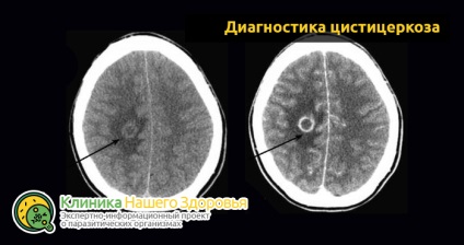 Paraziții din simptomele creierului, tipuri și tratament (creier) Paraziți în simptomele creierului, tipuri și tratament