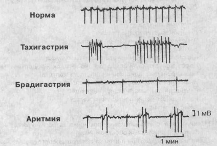 Gastropareza (gastric) pareză gastrică