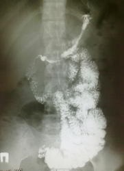 Pasajul radiologi bariu portal (radiologie) Pasajul de bariu, portal radiologi