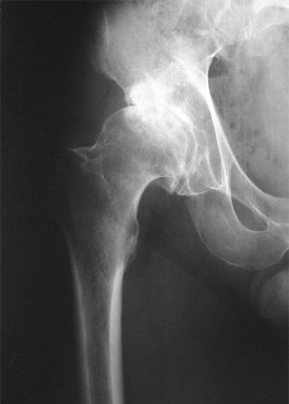 artroplastie primara, osteoporoza Center (artroplastie) artroplastia primar, osteoporoza Centrul