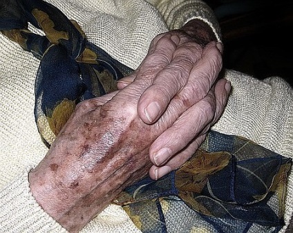 Petele si hormoni (pigment) Spoturi si hormoni