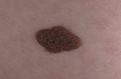 Border nevi pigmentat fotografie, simptome si cauze, diagnostic, tratament (motive) Border nevi pigmentat fotografie, simptome si cauze, diagnostic, tratament
