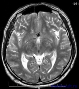 Consecințele hemoragie subarahnoidiană (cerebral măduva spinării) Consecințele hemoragie subarahnoidiană