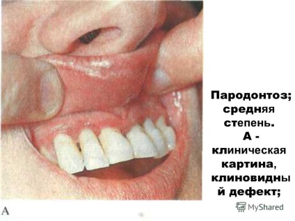 Prezentare generală asupra bolii parodontale și periodontita (boala parodontală și periodontita. Clinic. Metode de cercetare) Prezentarea privind boala parodontala si parodontita