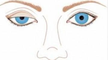 ptozei capacului superior cauze, tratament fara stredstv popular chirurgie, evaluări, după botox în (sus) ptoza pleoapei superioare cauze, tratament fara chirurgie, stredstv populară comentarii, după Botox în