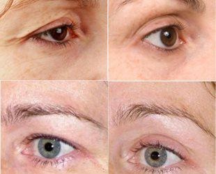 ptozei capacului superior cauze, tratament fara stredstv popular chirurgie, rating, după botox în (tratament) ptoza pleoapei superioare cauze, tratament fara chirurgie, stredstv populară comentarii, după Botox în
